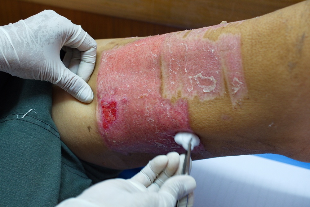 skin graft surgery after motorcycle accident